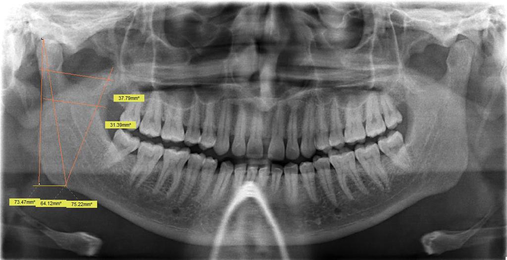Ideal orthopantomographs were selected for the study. Pathological, fractured, deformed and developmental disturbances of the mandible were excluded from the study.