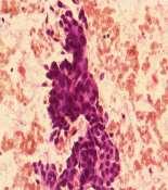 histology were reported s mstitis t cytology (flse negtive dignosis in disese) One cse of Tuerculr mstitis ws