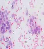 s intrductl crcinom in histology were reported s enign prolifertive rest disese in cytology (flse negtive dignosis