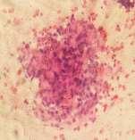 One cse reported s intrductl crcinom disese in histology ws reported s Hypocellulr in cytology (flse negtive