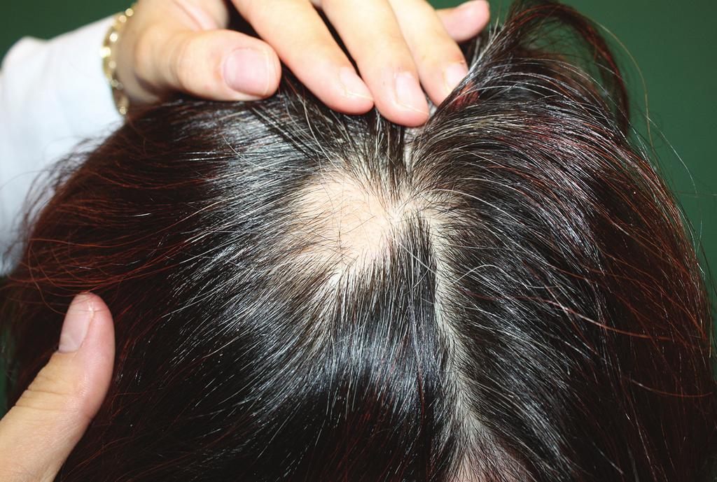 108 Hair and Scalp Disorders Figure 1. Circular area of nonscarring alopecia incidentally found in an adult patient. Nail changes are observed in up to 7 66% of patients [15].