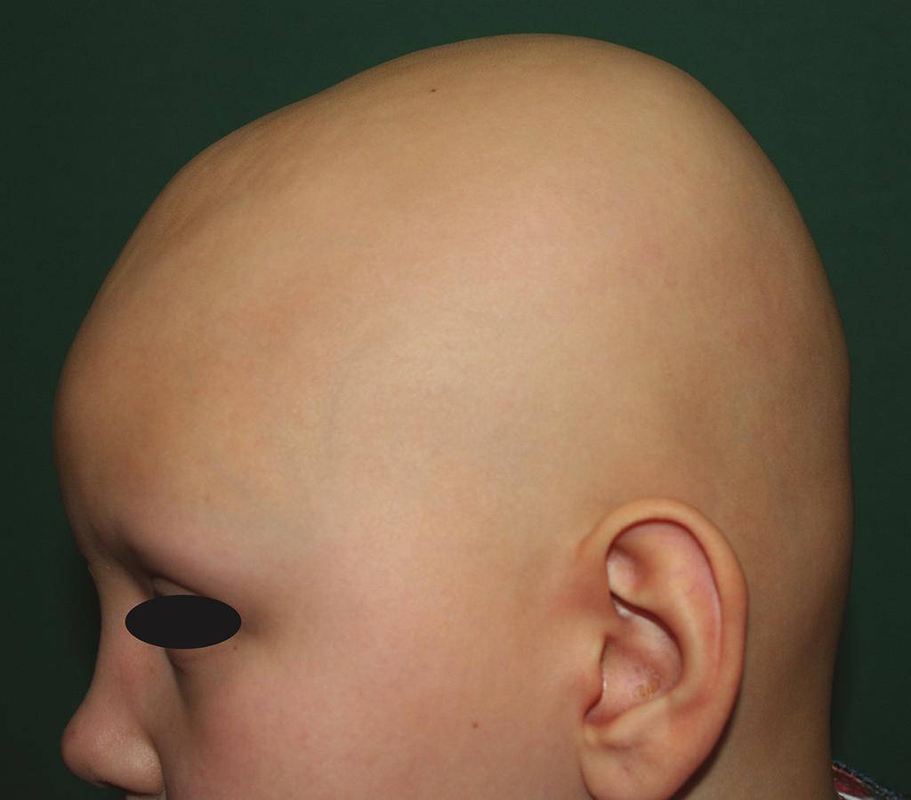 Alopecia Areata http://dx.doi.org/10.5772/66594 109 Figure 2. A patient with alopecia universalis having total loss of scalp hair and eyebrows.