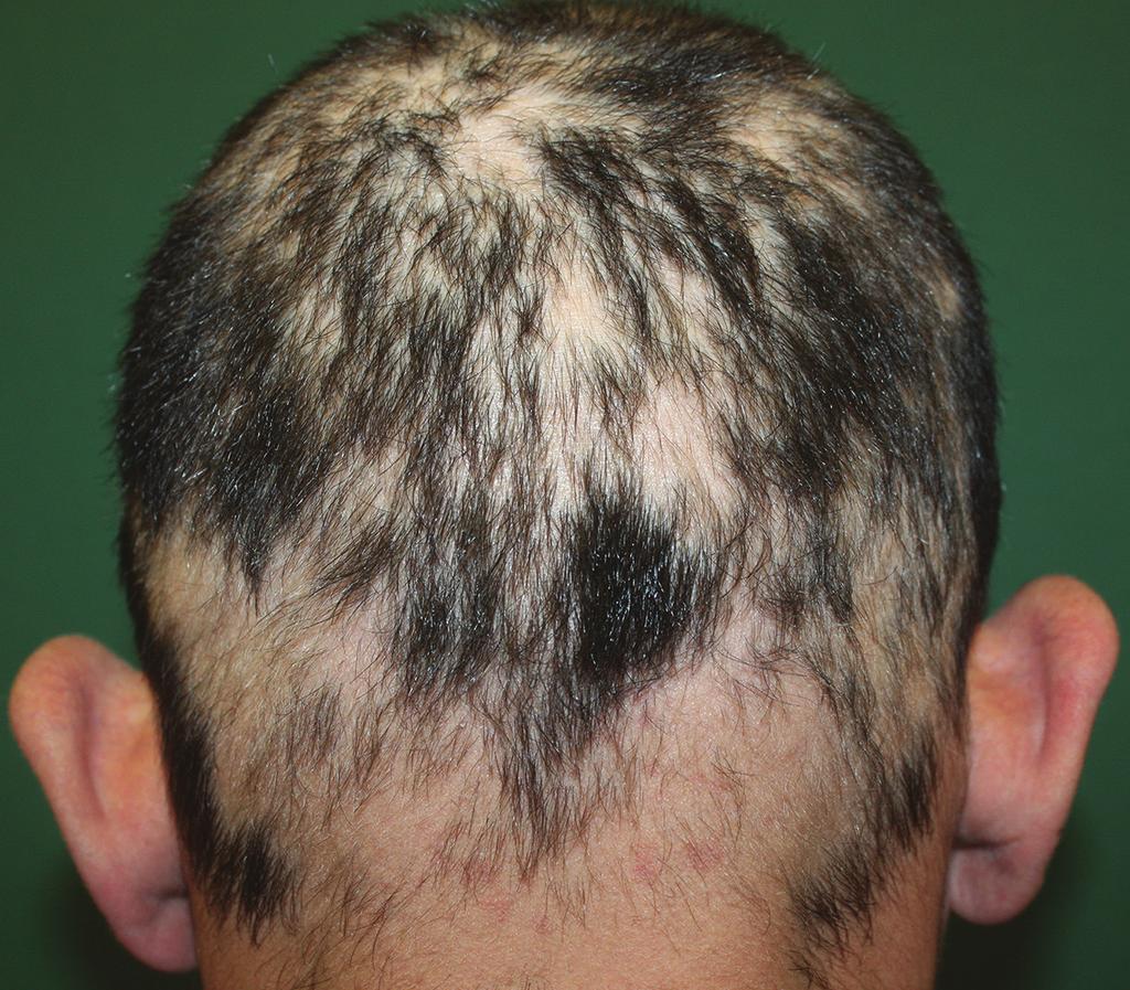 110 Hair and Scalp Disorders Figure 3. Reticular type alopecia areata with a net-like pattern. 6.