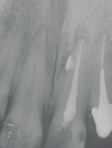 order to improve root canal vacuity in the narrow canals.