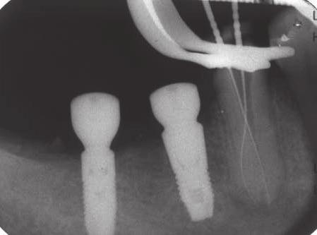 Roger Rebeiz (1) (2) (1) Pre-op X-ray (2) Root canal
