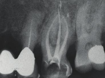 molar: narrow canals and