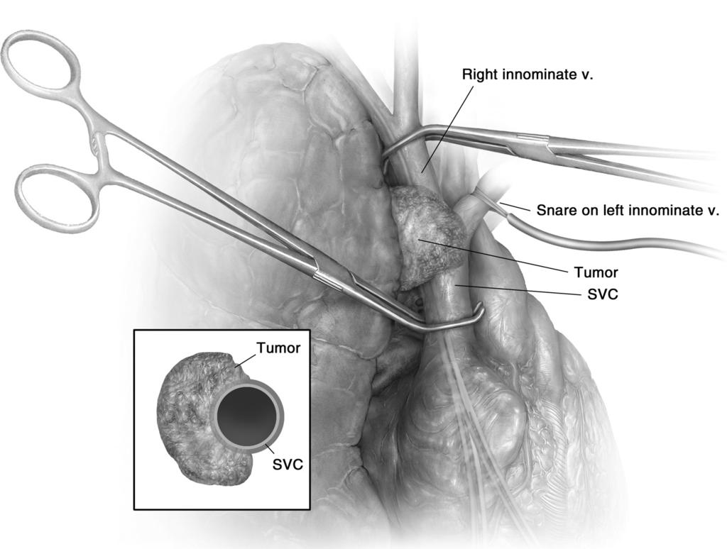 280 D.R. Jones Figure 6 Extensive tumor involvement of the SVC. When tumors involve more than 50% of the circumference of the SVC, complete resection and reconstruction of the SVC is indicated.
