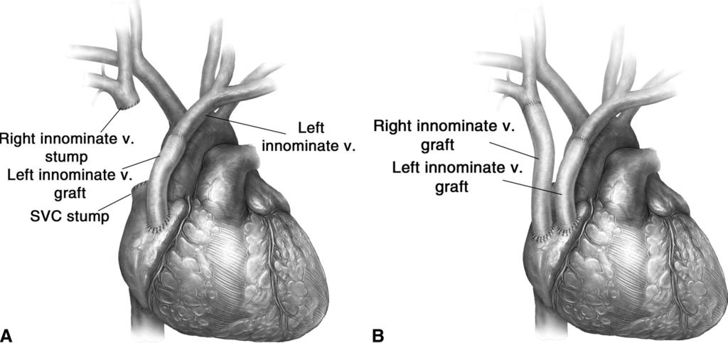 In general, there is no need to reconstruct the left innominate vein provided there are adequate collaterals.