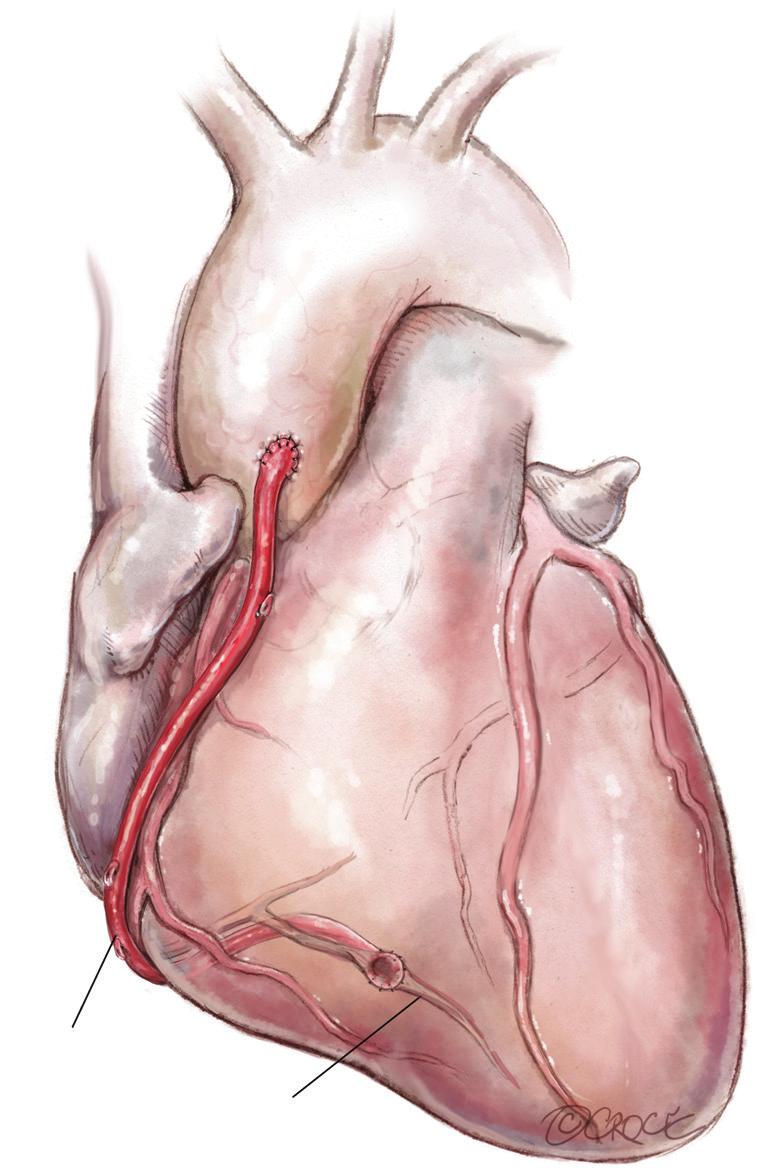 (may require extension by recycled /RA/SVG) The advantage of this technique is to avoid any arterial graft crossing the mid line in case of eventual need for redo sternotomy.