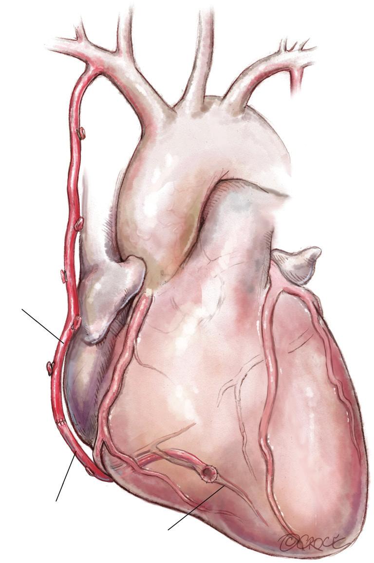 Annals of cardiothoracic surgery, Vol 7, No 5 September 2018 695 Figure 8: In situ with extension by RA The will commonly not reach the PDA even after full skeletonization and can be extended with