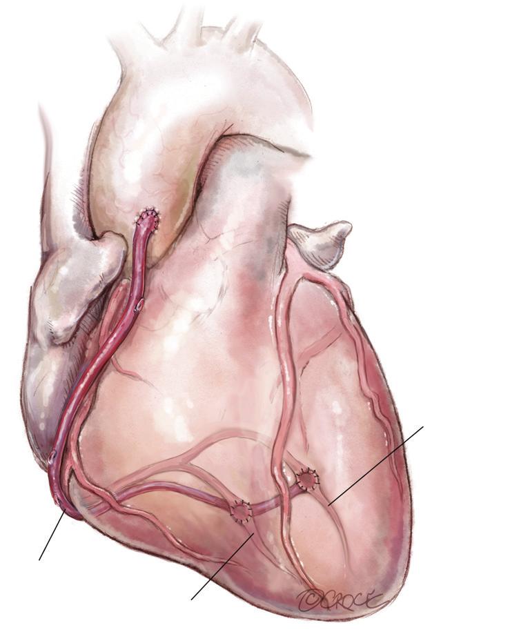 As described for Figure 7, an alternative strategy is to anastomose the RA or SVG to the proximal in situ, especially if a no touch aortic technique is indicated, with the main body of the being used
