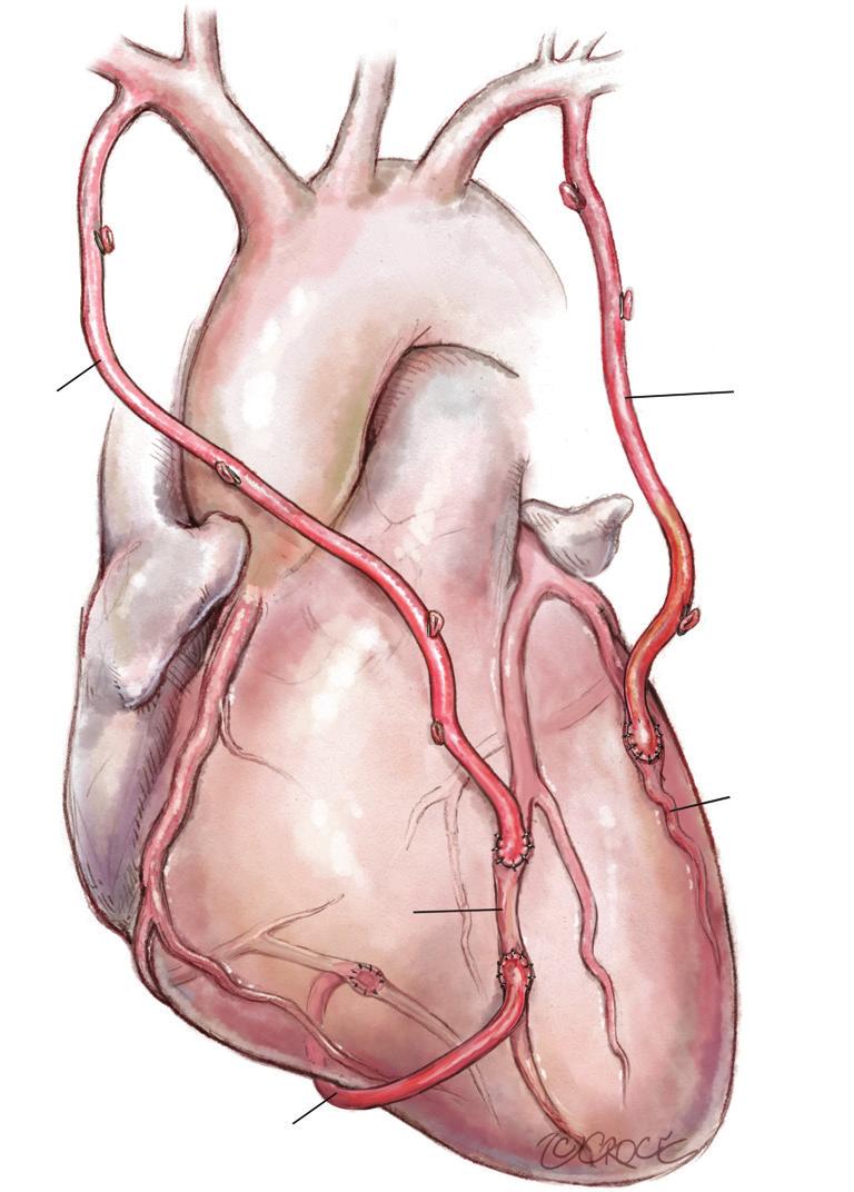 Gastroepiploic PDA Figure 10 Use of a gastroepiploic (GEA) for the inferior wall.