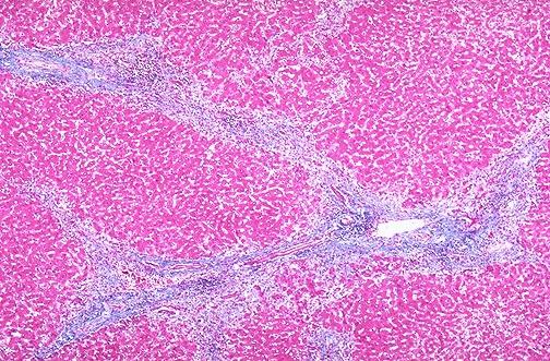 This trichrome stain demonstrates the collapse of the liver parenchyma with viral hepatitis.