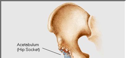 Reaming the Acetabulum After the femoral head is removed, the