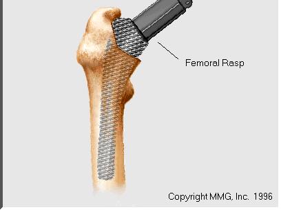 the femoral component.