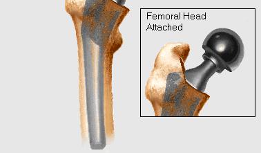 replaces the femoral head