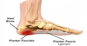 What is Plantar Fasciitis: The plantar fascia is the band of tissue that runs along the bottom of the foot, connecting the heel bone to the toes.