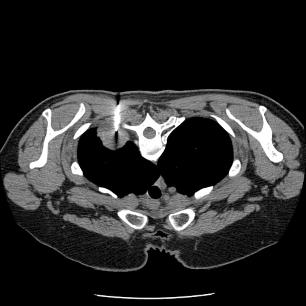 Fig. 1: 61-year-old woman with squamous cell carcinoma in left upper lobe diagnosed at conventional CT-guided biopsy (conventional method). Initial puncture was performed without penetrating pleura.