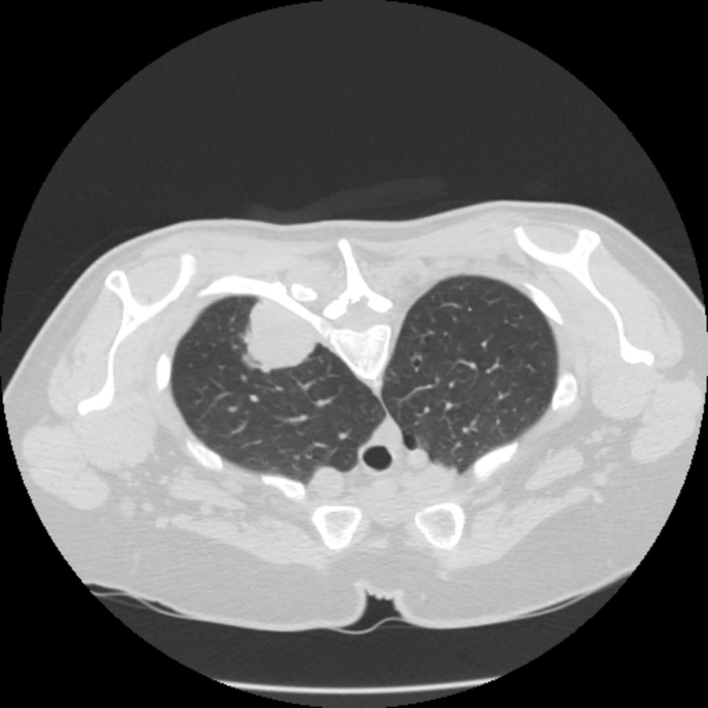 Fig. 2: 61-year-old woman with squamous cell carcinoma in left upper lobe diagnosed at conventional CT-guided biopsy (conventional method).