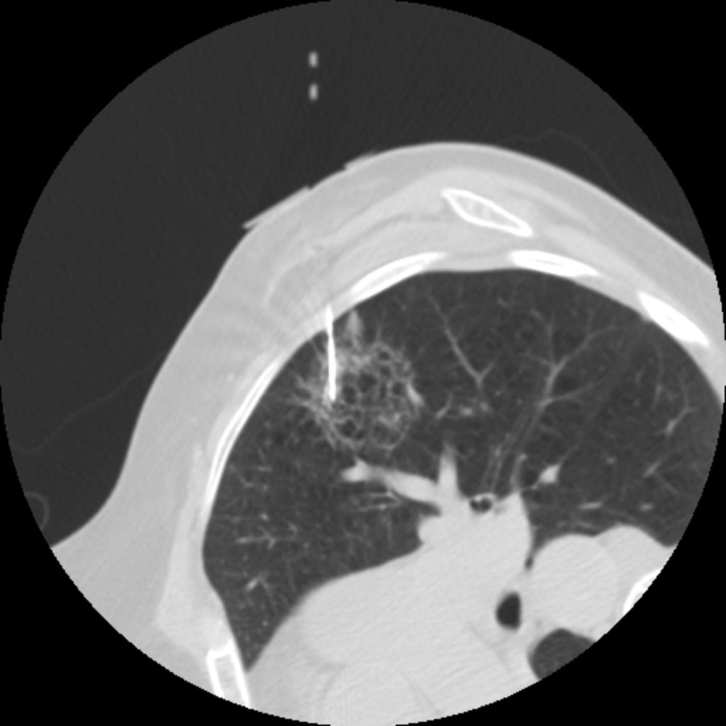 Fig. 3: 65 year-old woman with ground-glass opacity nodule (adenocarcinoma) diagnosed at fluoroscopy CT-guided biopsy.