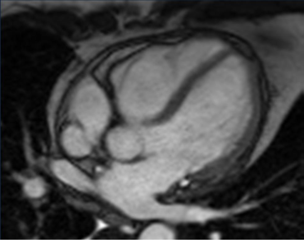 echocardiography Myocardial tagging Systole: slippage