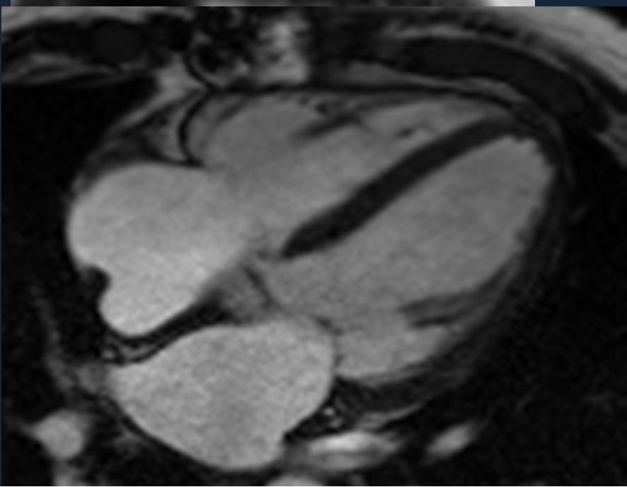 cannot expand o In early diastole RV