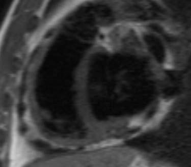 calcifications in setting of suggestive