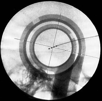 Targeting the STN for deep brain stimulation 411 Figure 3 An intraoperative image intensifier picture, showing the centre of the electrode array at the target point (in the centre of the rings of the