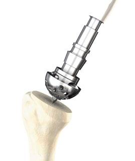 Metaphyseal Reaming This system uses one metaphyseal size to accommodate both a 36 mm and 42 mm glenoid sphere.