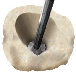 you find a distal trial with a snug fit where there is not rotation of the joint.
