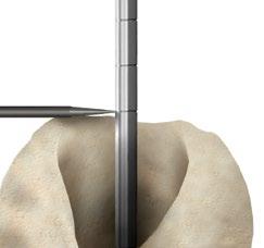In the same manner, this step can help the surgeon assess the stem size required for cemented application.