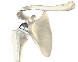 The instrumentation allows either a standard glenoid preparation or a cannulated preparation referencing a guide pin positioned at a chosen orientation.