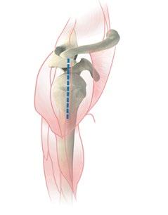 Next, the subscapularis bursa is released and the humeral head is dislocated by placing the arm in flexion and external rotation.