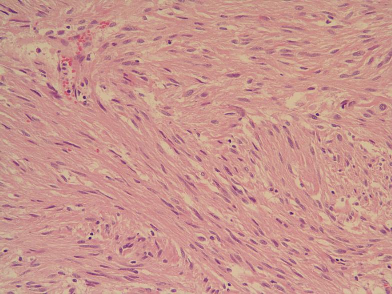 wall. Fig. 3. Tumors are composed of interlacing fascicles of uniform spindle cells with eosinophilic cytoplasm and elongated nuclei (H&E, 100).