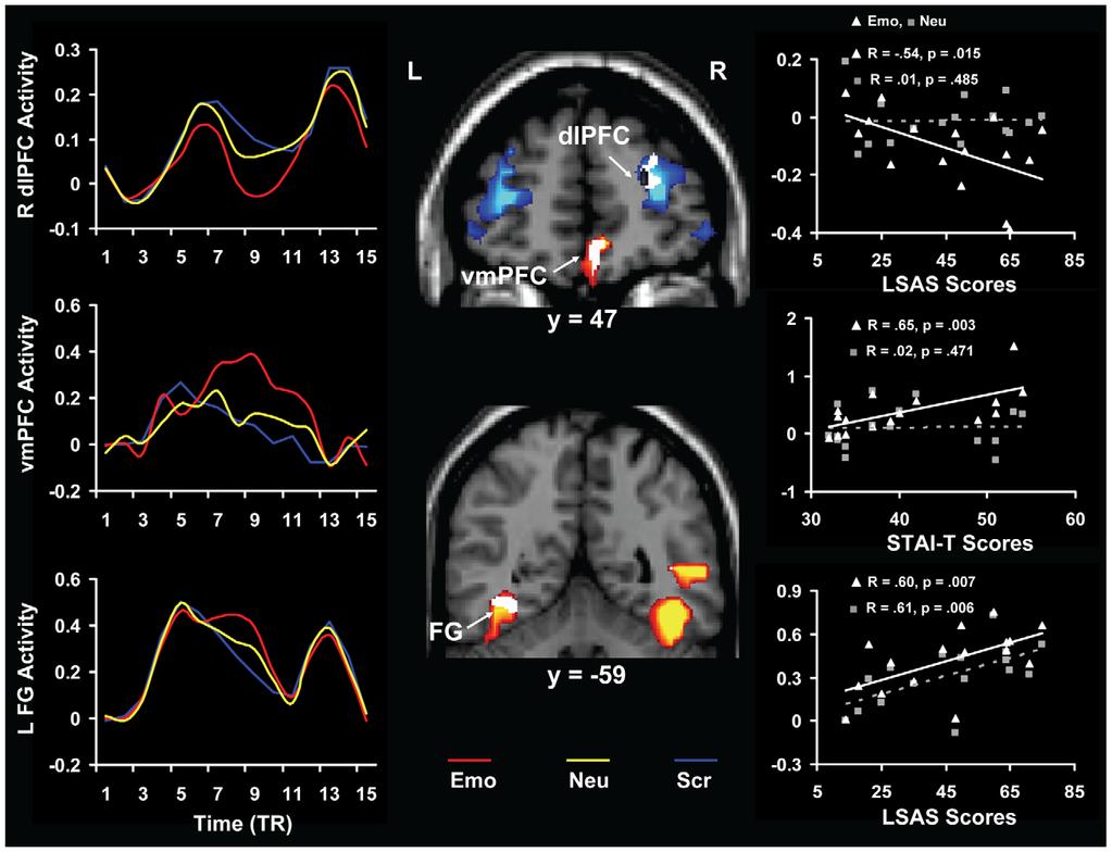 Figure 3. Opposite patterns of activity and co-variation in the ventral vs. dorsal neural systems in the presence of anxiety-inducing distracters.