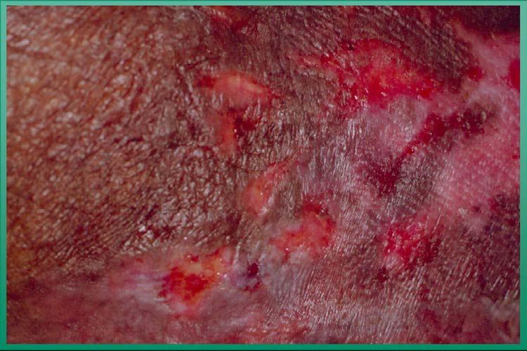 Stage II Partial thickness loss of dermis presenting as a shallow open ulcer with a red pink wound