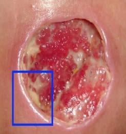 the epidermal cells to cross the wound bed Needs to be removed