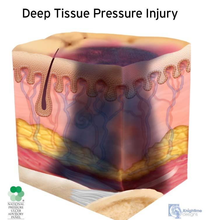 Deep Tissue Pressure Injury: Persistent non-blanchable deep red, maroon or purple discoloration Intact or non-intact skin with localized area of persistent nonblanchable deep red, maroon, purple