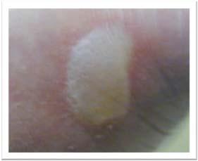 Stage 1 Pressure Injury with Edema Stage 2 Pressure Ulcer: Partial thickness Skin Loss with