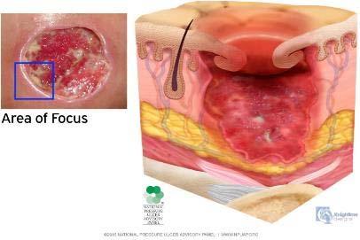 Stage 3 Pressure Ulcer: Pressure Injury: Full thickness Skin Loss Full thickness loss of skin, in which subcutaneous fat may be visible in the ulcer and granulation tissue and epibole (rolled wound