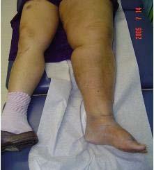 Neuropathic Foot Ulcer Lymphedema Chronic wound etiologies other than pressure must have good wound