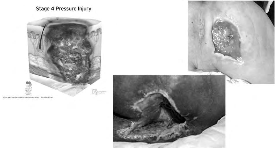 STAGE IV PRESSURE ULCER STAGE 4 PRESSURE INJURY Full thickness skin and tissue loss: Exposed fascia, muscle, tendon, ligament, cartilage or bone Slough