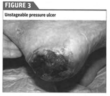 UNSTAGEABLE PRESSURE INJURY Obscured
