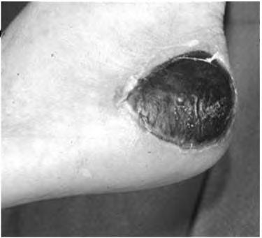 25-30% of non-healing Stage 4 ulcers If + follow with bone biopsy and culture WOUND DEBRIDEMENT DEFINED Removal from