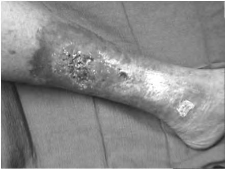 injury Distinct from other chronic wounds Venous,