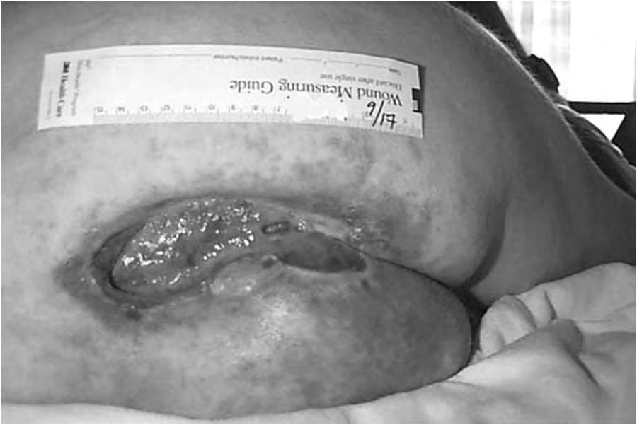 CASE EXAMPLES What type of ulcer? Important ulcer characteristics?