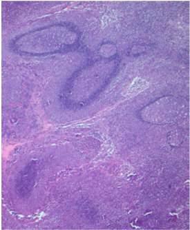 Gastic MALT lymphoma Gastric MALT lymphoma: MZ B cells neoplastic B cells form