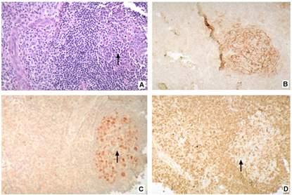 lymphoma Marginal zone/malt lymphoma: Immunophenotype Immunoglobulin + (M>G>A; D-); cig