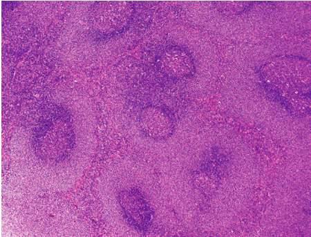 Marginal zone/malt lymphoma: Genetics Cytogenetics Trisomy 3: 60% t(11;18)(q21;q21): 40% do not respond to H. pylori eradicaton t(1;14): rare Gastric MALT Lymphoma:Treatment H.