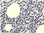 Extranodal marginal zone B-cell lymphoma (MALT type) Nodal marginal zone B-cell lymphoma Follicular lymphoma Primary
